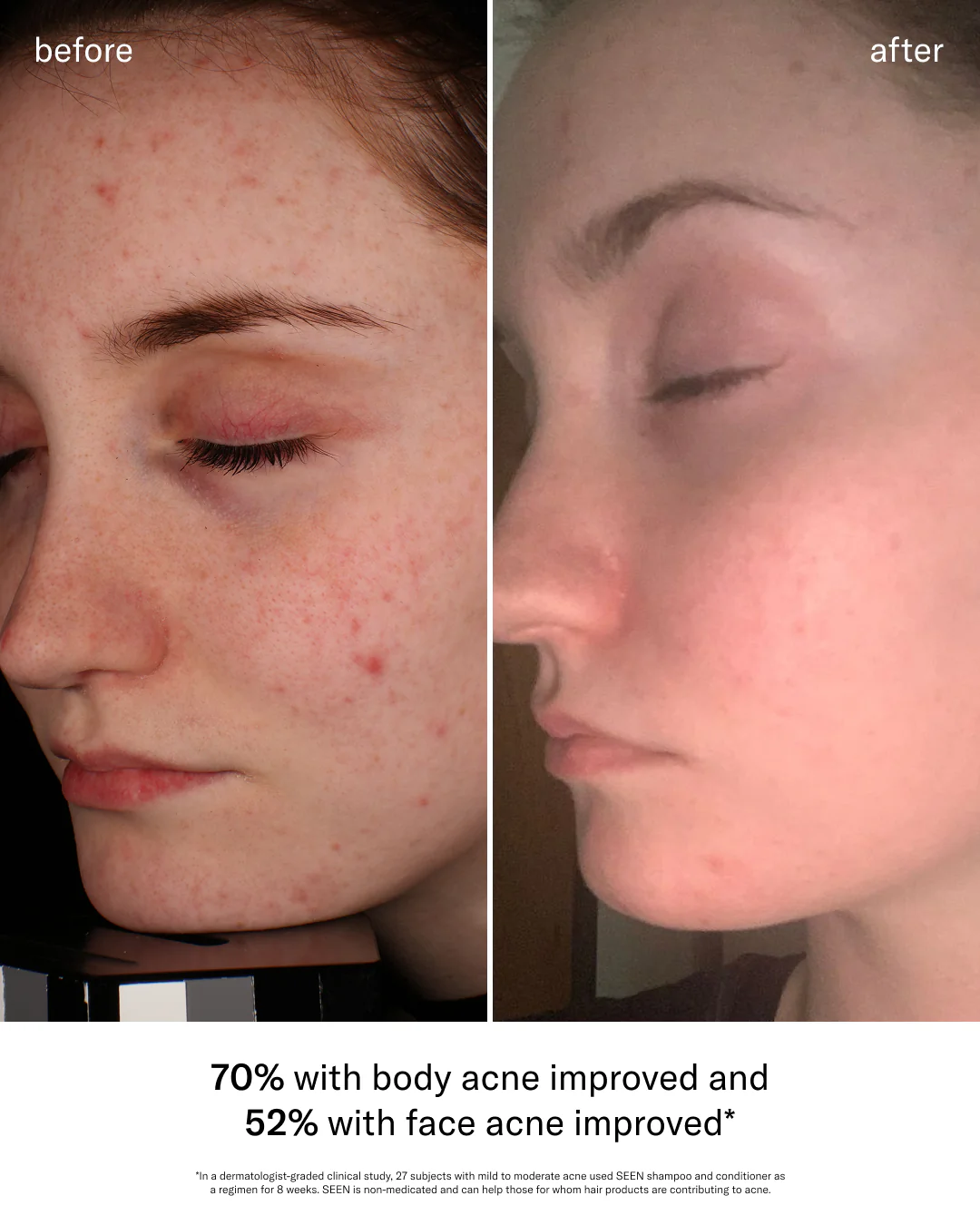 SEEN Acne-Safe Bundle, Fragrance Free - Image 5